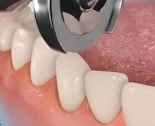 拔牙齿照片,揭秘拔牙过程与术后护理